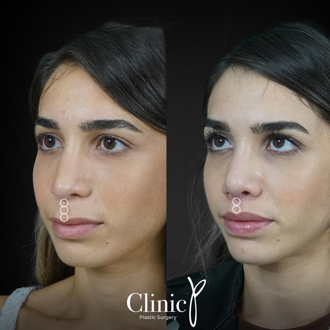 Lip Lift Clinic P Aesthetic Surgery Turkey lip-lift-clinic-p-aesthetic-surgery-turkey