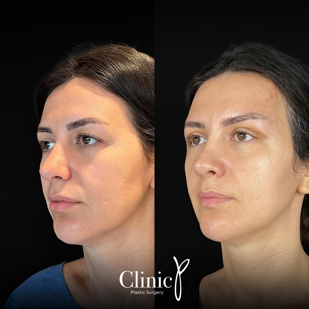 Temporal Lift – Clinic P | Aesthetic Surgery Turkey